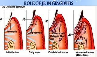 ROLE OF JE IN GINGIVITIS
 