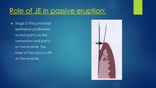 Role of JE in passive eruption:
 Stage 2: The junctional
epithelium proliferates
so that part is on the
cementum and part is
on the enamel. The
base of the sulcus is still
on the enamel.
 