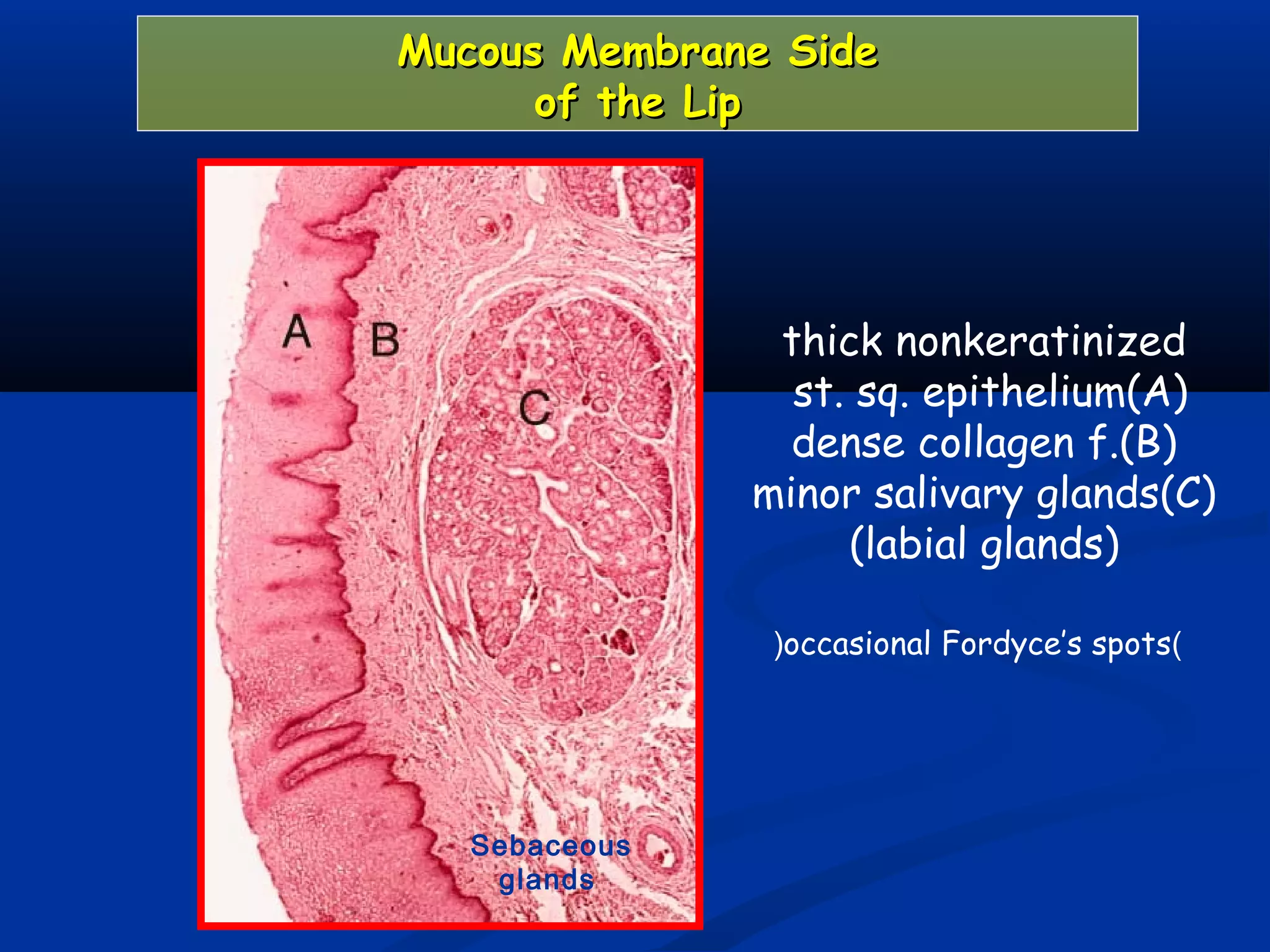 Mucous Membrane SideMucous Membrane Side
of the Lipof the Lip
thick nonkeratinized
st. sq. epithelium(A)
dense collagen f.(B)
minor salivary glands(C)
(labial glands)
Sebaceous
glands
)occasional Fordyce’s spots(
 