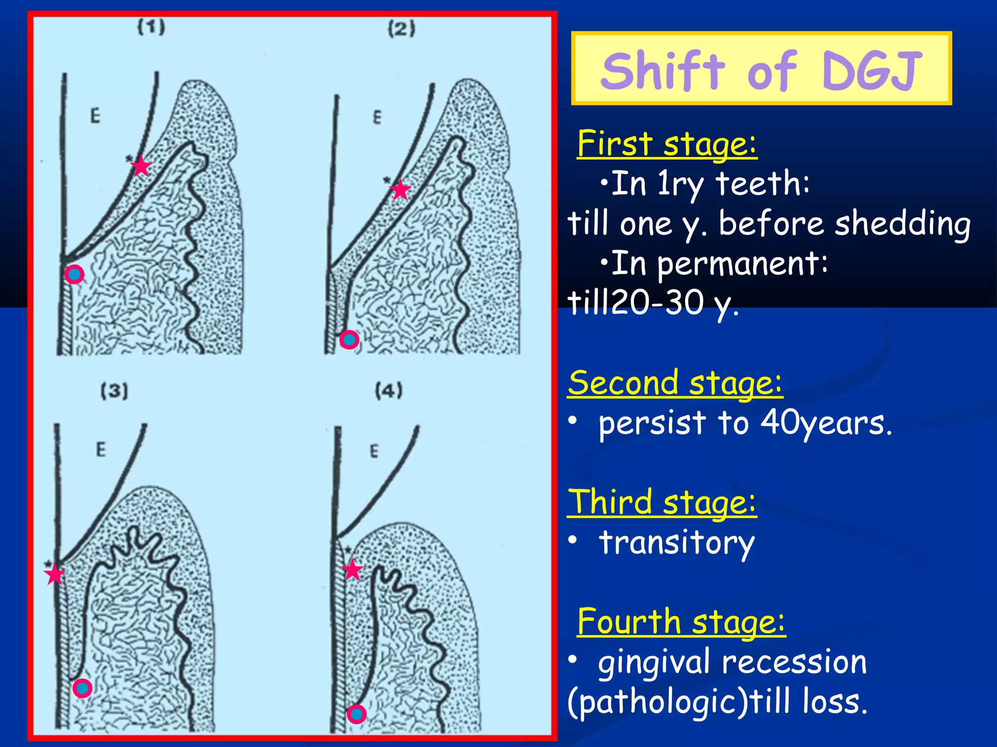 Shift of DGJ
First stage:
•In 1ry teeth:
till one y. before shedding
•In permanent:
till20-30 y.
Second stage:
• persist to 40years.
Third stage:
• transitory
Fourth stage:
• gingival recession
(pathologic)till loss.
 