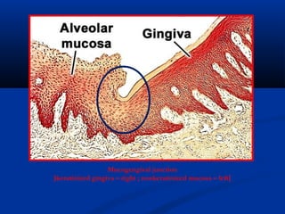 Mucogengival junction
)keratinized gingiva – right ; nonkeratinized mucosa – left(
 