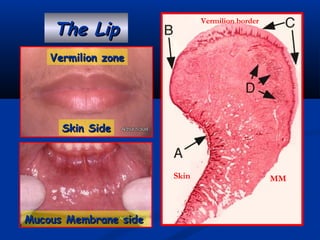 The LipThe Lip
Skin SideSkin Side
Vermilion zoneVermilion zone
Mucous Membrane sideMucous Membrane side
Vermilion border
MMSkin
 