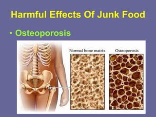 Harmful Effects Of Junk Food Osteoporosis 