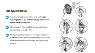 Percutaneous Incision JURDING UPJO. Brief Introduction about percutaneous management UPJO | PPTX