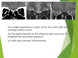 Nontraumatic Orbital Emergencies: CT and MRI Imaging Insights | PPTX