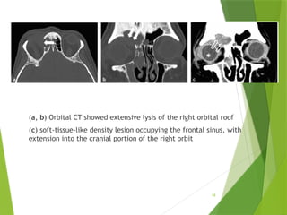 Nontraumatic Orbital Emergencies: CT and MRI Imaging Insights | PPTX