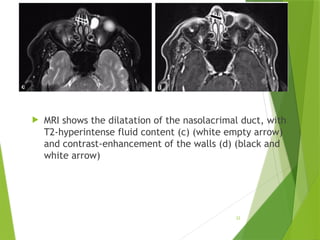 Nontraumatic Orbital Emergencies: CT and MRI Imaging Insights | PPTX