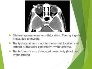 Nontraumatic Orbital Emergencies: CT and MRI Imaging Insights | PPTX