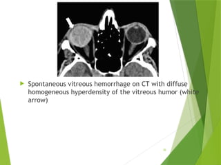 Nontraumatic Orbital Emergencies: CT and MRI Imaging Insights | PPTX