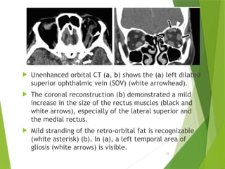 Nontraumatic Orbital Emergencies: CT and MRI Imaging Insights | PPTX