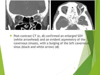 Nontraumatic Orbital Emergencies: CT and MRI Imaging Insights | PPTX