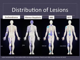 Distribu:on	
  of	
  Lesions	
  
        Enchondroma	
                                      Fibrous	
  Dysplasia	
                                          ABC	
                                          GCT	
  




Layout	
  and	
  distribuLon:	
  Frank	
  Gaillard	
  2009,	
  Line	
  drawing	
  of	
  skeleton:	
  Patrick	
  Lynch	
  2006,	
  CreaLve	
  Common	
  NC-­‐SA-­‐BY	
  
 