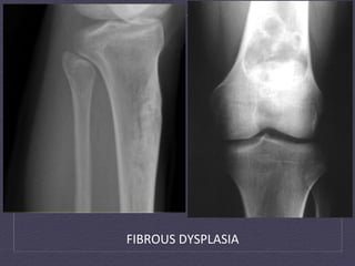 FIBROUS	
  DYSPLASIA	
  
 
