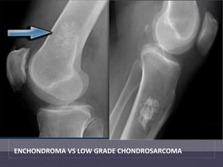 ENCHONDROMA	
  VS	
  LOW	
  GRADE	
  CHONDROSARCOMA	
  
 