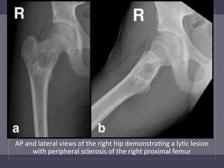 AP	
  and	
  lateral	
  views	
  of	
  the	
  right	
  hip	
  demonstra:ng	
  a	
  ly:c	
  lesion	
  
        with	
  peripheral	
  sclerosis	
  of	
  the	
  right	
  proximal	
  femur	
  
 
