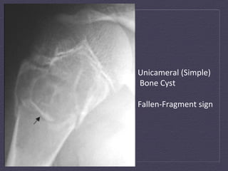 Unicameral	
  (Simple)	
  
	
  Bone	
  Cyst	
  
	
  
Fallen-­‐Fragment	
  sign	
  
 