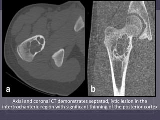 Axial	
  and	
  coronal	
  CT	
  demonstrates	
  septated,	
  ly:c	
  lesion	
  in	
  the	
  
intertrochanteric	
  region	
  with	
  signiﬁcant	
  thinning	
  of	
  the	
  posterior	
  cortex	
  
 