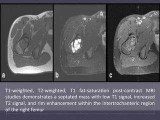 T1-­‐weighted,	
   T2-­‐weighted,	
   T1	
   fat-­‐satura:on	
   post-­‐contrast	
   MRI	
  
studies	
  demonstrates	
  a	
  septated	
  mass	
  with	
  low	
  T1	
  signal,	
  increased	
  
T2	
  signal,	
  and	
  rim	
  enhancement	
  within	
  the	
  intertrochanteric	
  region	
  
of	
  the	
  right	
  femur	
  
 