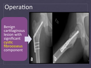 Opera:on	
  

Benign	
  
car:laginous	
  
lesion	
  with	
  
signiﬁcant	
  
cys:c	
  
ﬁbroosseus	
  
component	
  
 