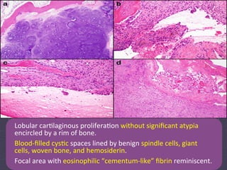 Lobular	
  car:laginous	
  prolifera:on	
  without	
  signiﬁcant	
  atypia	
  
encircled	
  by	
  a	
  rim	
  of	
  bone.	
  
Blood-­‐ﬁlled	
  cys:c	
  spaces	
  lined	
  by	
  benign	
  spindle	
  cells,	
  giant	
  
cells,	
  woven	
  bone,	
  and	
  hemosiderin.	
  
Focal	
  area	
  with	
  eosinophilic	
  “cementum-­‐like”	
  ﬁbrin	
  reminiscent.	
  
 