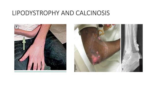 Juvenile dermatomyositis.pptx | Physical Therapy | Wellness