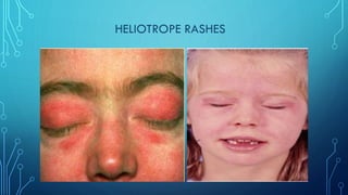 Haliotrop Rash Comprehensive Overview of Juvenile Dermatomyositis: Diagnosis, Clinical ...
