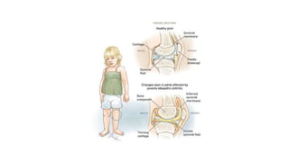 Juvenile Idiopathic Arthritis | PPTX