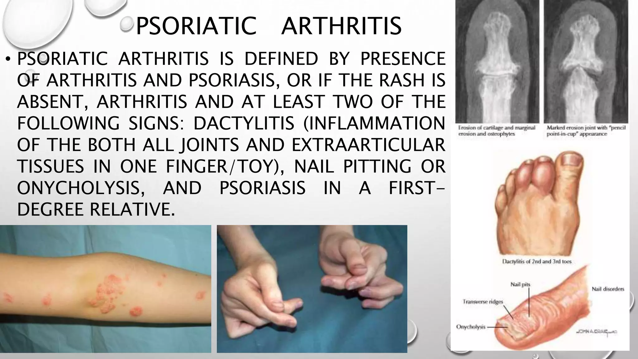 juvenile-idiopathic-arthritis-pptx