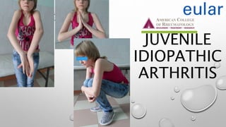 JUVENILE
IDIOPATHIC
ARTHRITIS
 