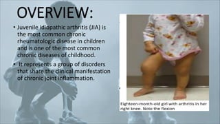 JUVENILE IDIOPATHIC ARTHRITIS by Dr Arslan.pdf
