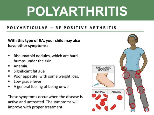 Juvenile idiopathic arthritis (JIA)