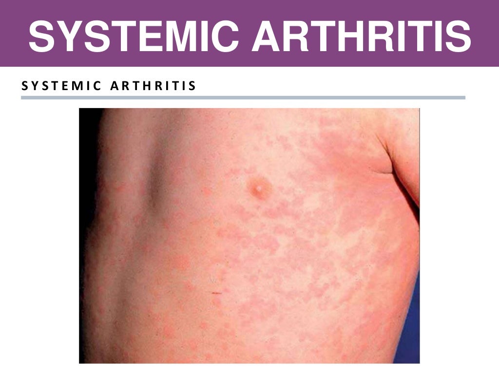 Juvenile idiopathic arthritis (JIA)