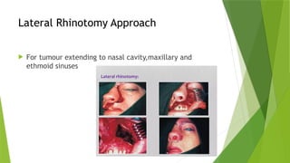 Nasal Rhinotomy JUVENILE NASOPHARYNGEAL ANGIOFIBROMA.pptx