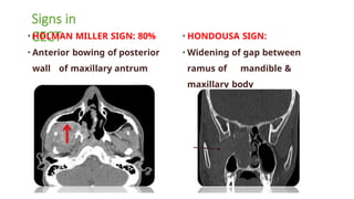 Comprehensive Overview of Juvenile Nasopharyngeal Angiofibroma ...