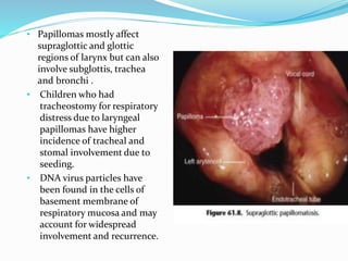 • Papillomas mostly affect
supraglottic and glottic
regions of larynx but can also
involve subglottis, trachea
and bronchi .
• Children who had
tracheostomy for respiratory
distress due to laryngeal
papillomas have higher
incidence of tracheal and
stomal involvement due to
seeding.
• DNA virus particles have
been found in the cells of
basement membrane of
respiratory mucosa and may
account for widespread
involvement and recurrence.
 
