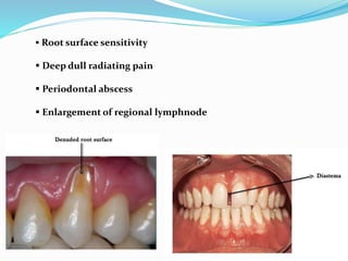  Root surface sensitivity
 Deep dull radiating pain
 Periodontal abscess
 Enlargement of regional lymphnode
 
