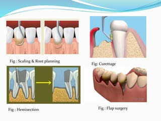 Fig : Scaling & Root planning
Fig: Curettage
Fig : Hemisection Fig : Flap surgery
 