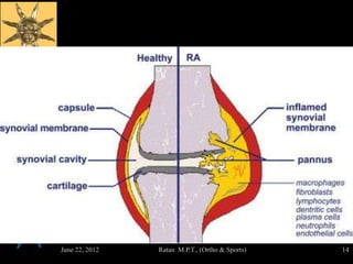 June 22, 2012   Ratan M.P.T., (Ortho & Sports)   14
 