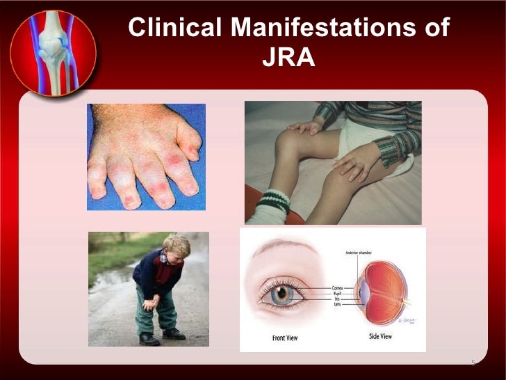 presentation of juvenile rheumatoid arthritis