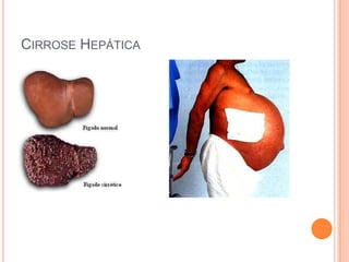 CIRROSE HEPÁTICA
 