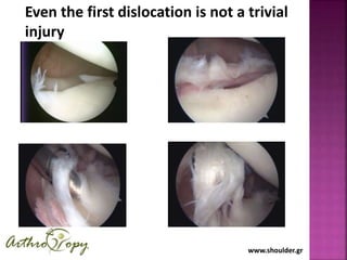 www.shoulder.grwww.shoulder.gr
Even the first dislocation is not a trivial
injury
 