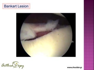 www.shoulder.grwww.shoulder.gr
Bankart Lesion
 