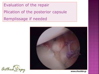 www.shoulder.gr
Evaluation of the repair
Plication of the posterior capsule
Remplissage if needed
 