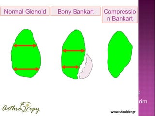 www.shoulder.gr
Normal Glenoid
inverted
pear
Bony Bankart
pear
Compressio
n Bankart
loss of
anterior rim
 