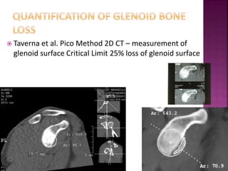 www.shoulder.gr
 Taverna et al. Pico Method 2D CT – measurement of
glenoid surface Critical Limit 25% loss of glenoid surface
 