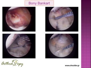 www.shoulder.gr
Bony Bankart
 