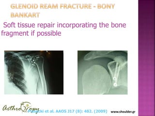 www.shoulder.gr
Soft tissue repair incorporating the bone
fragment if possible
Piasecki et al. AAOS J17 (8): 482. (2009)
 