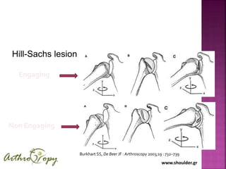 www.shoulder.gr
Engaging
Non Engaging
Burkhart SS, De Beer JF : Arthroscopy 2003;19 : 732–739
Hill-Sachs lesion
 