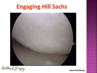 www.shoulder.grwww.shoulder.gr
Engaging Hill Sachs
 