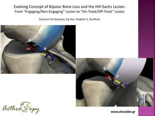 www.shoulder.grwww.shoulder.gr
Evolving Concept of Bipolar Bone Loss and the Hill-Sachs Lesion:
From “Engaging/Non-Engaging” Lesion to “On-Track/Off-Track” Lesion
Giovanni Di Giacomo, Eiji Itoi, Stephen S. Burkhart
 